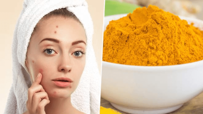 turmeric acne